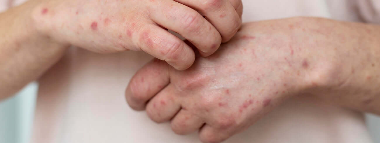 頻繁洗手引致手部乾癢？！係主婦手定濕疹？六招減輕敏感症狀！